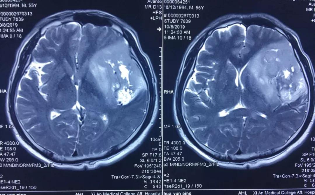西安国际医学中心脑科医院成功实施一例颅内巨大脑胶质瘤切除术