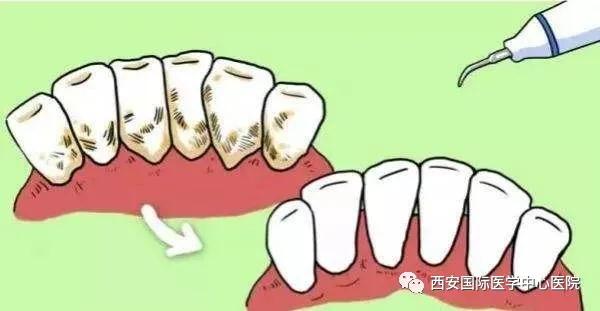 牙齿上的黄斑好难看，三招告诉你如何预防氟斑牙