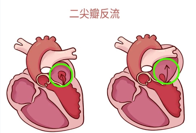 体检报告里的心脏瓣膜返流，你读懂了吗？