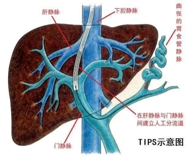 门静脉高压分流术图片