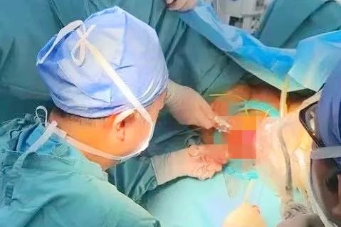 生命与尊严的守护——超低位直肠癌手术的“毫米级”挑战